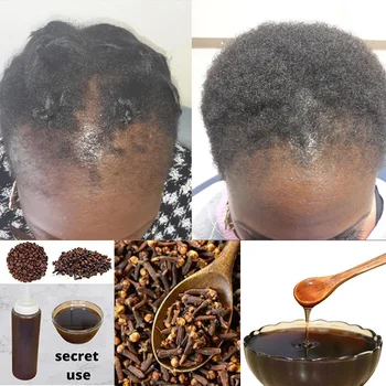 أفريقيا المرأة الجر تساقط الشعر علاج تساقط الشعر علاج للتخلص من الشعر المستعار المنتج نمو الشعر للرجال شامبو 300 مل العناية بالشعر