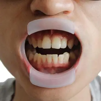 1PCS الأسنان O-الشكل داخل الفم والشفة والخد ضام الفم فتحت نظافة الفم تبييض الأسنان موسعات تقويم الأسنان هدفين أدوات